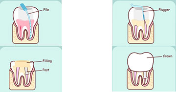 Root Canal-North Miami-Phanord